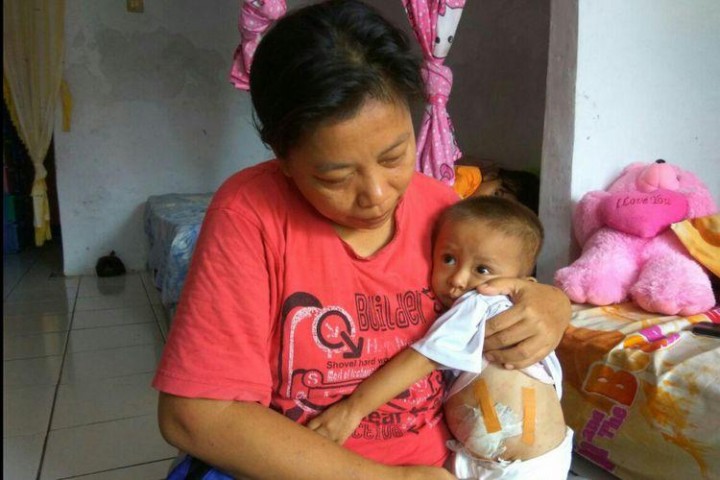 Kisah Iqbal, Bayi Tanpa Anus di Depok 